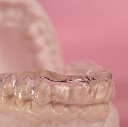 Oral appliance on model teeth