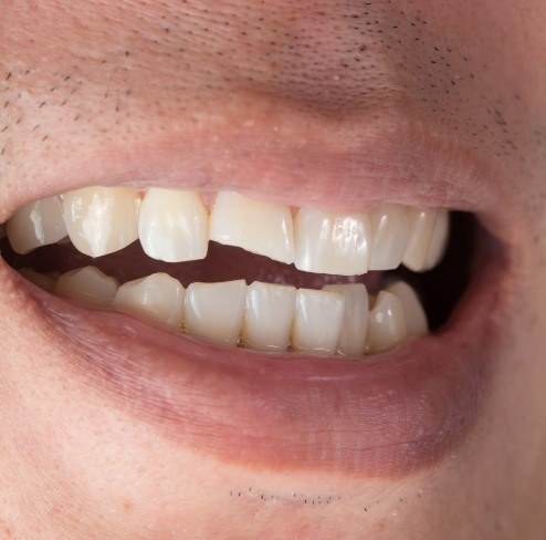 Damaged smile before dental bonding