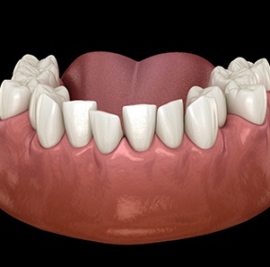 Illustration of crowded teeth