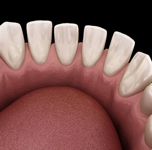 Illustration of  tooth gaps