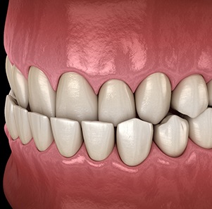 Illustration of  an underbite
