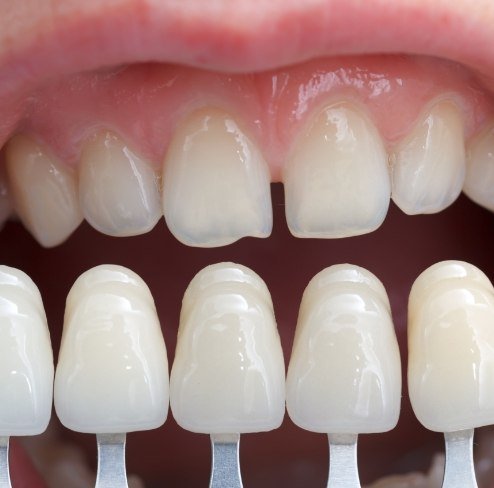 Smile compared to metal free dental restoration colors