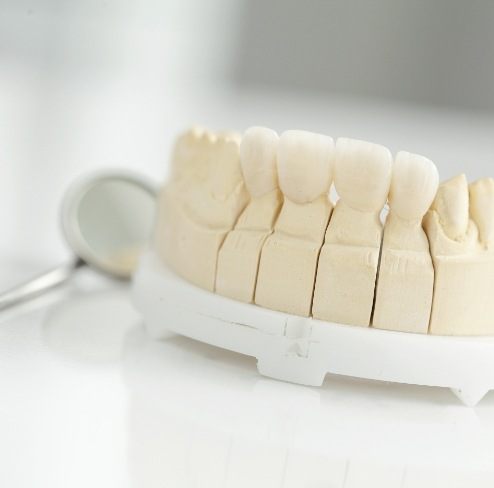 Model smile with dental bridge restoration
