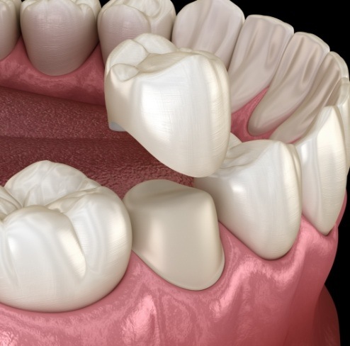 Animated smile during dental crown placement