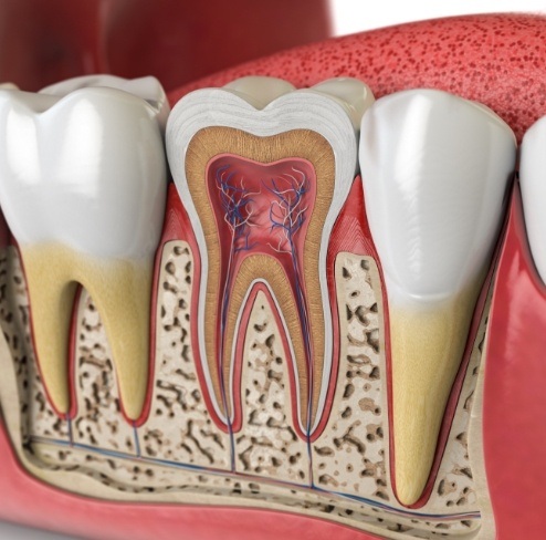 Animated tooth in need of root canal therapy