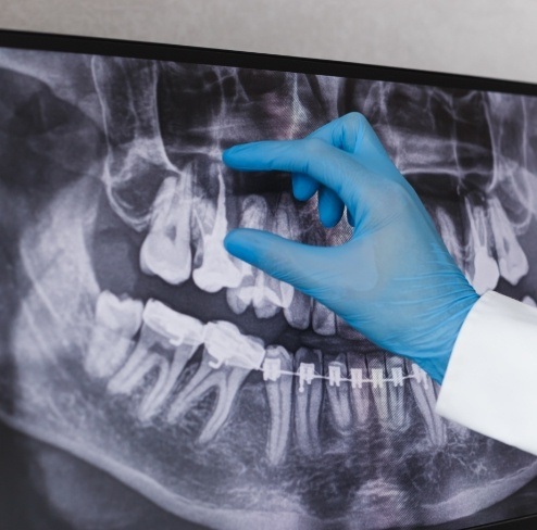 X-ray showing damaged tooth that needs to be extracted