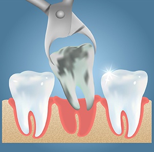 Drawing of a decayed tooth being extracted