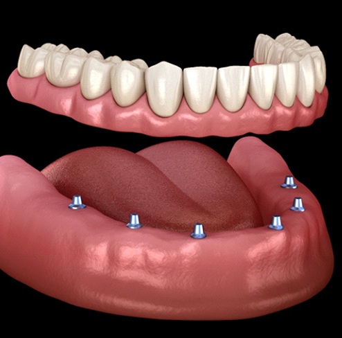 Diagram showing how implant dentures in Port Charlotte work