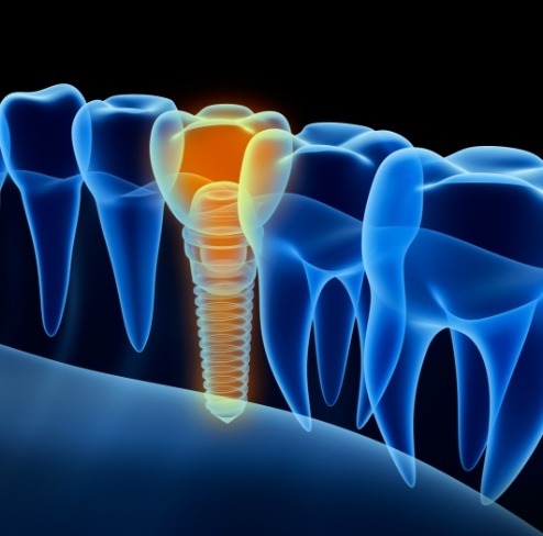 Animated smile with dental implant supported dental crown