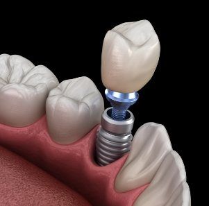 Animated smile during dental implant supported dental crown placement