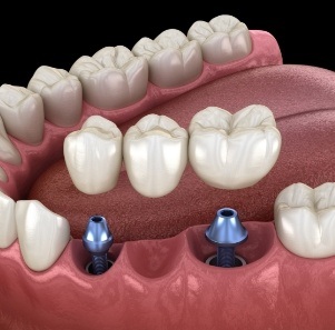 Animated smile during dental implant supported fixed bridge placement