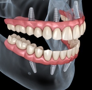 Animated smile during dental implant supported denture placement