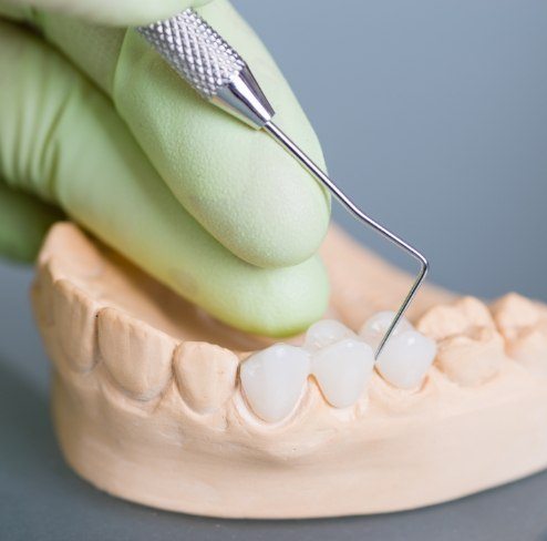 Model smile with dental bridge restoration