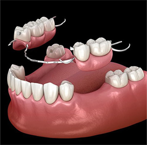 Man with dentures smiling