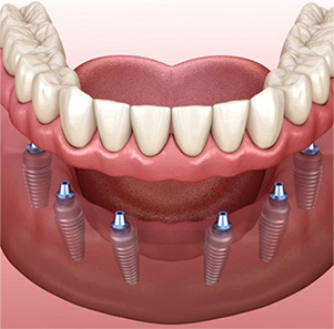 Man with dentures smiling