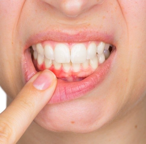 Closeup of patient's smile with red gums before periodontal treatment