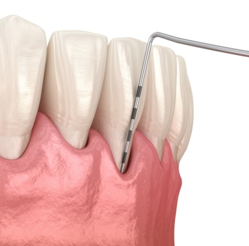 Animated smile during gum disease diagnosis