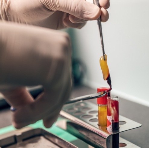 platelet rich fibrin being prepared