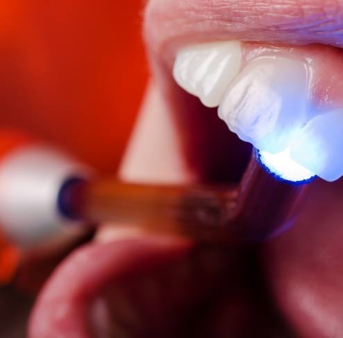 Closeup of patient receiving dental sealants