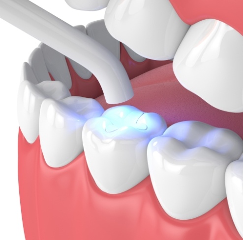 Animated smile receiving dental sealants