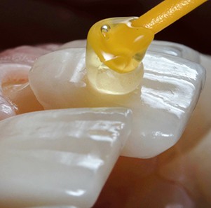 dental veneers being placed on teeth