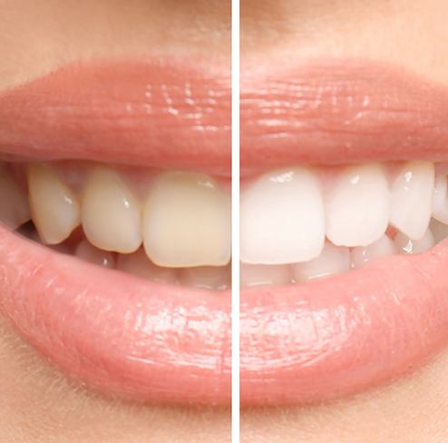 a before/after photo of teeth whitening results