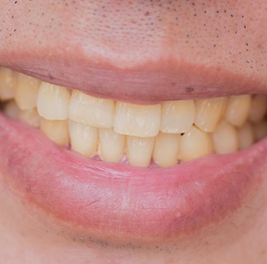 a person with stained teeth
