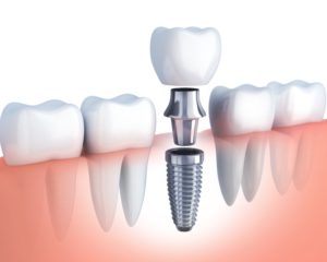 dental implants illustration 