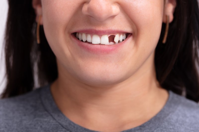 A woman smiling with a tooth missing after tooth extraction